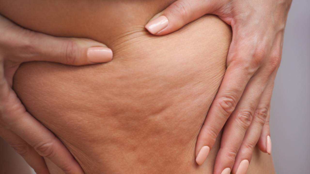 Eliminare la cellulite